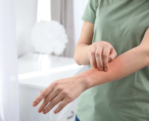 mast cell activation syndrome